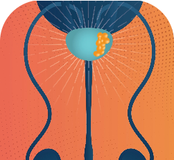 AstraZeneca in prostate cancer